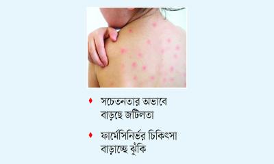 হাম উপসর্গে হাসপাতালে চাপ