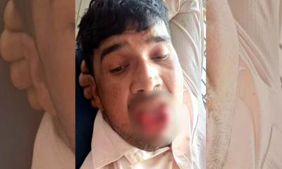 কামড়ে প্রেমিকের জিহ্বা ছিঁড়ে ফেললেন প্রেমিকা