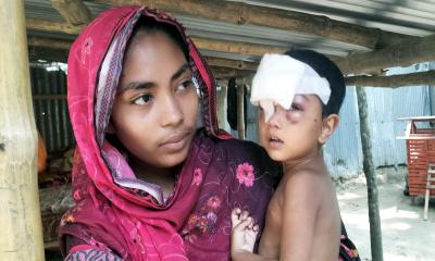 অর্থাভাবে চিকিৎসা অনিশ্চিত, কুকুরের কামড়ে শিশুর চোখ-মুখে গুরুতর ক্ষত